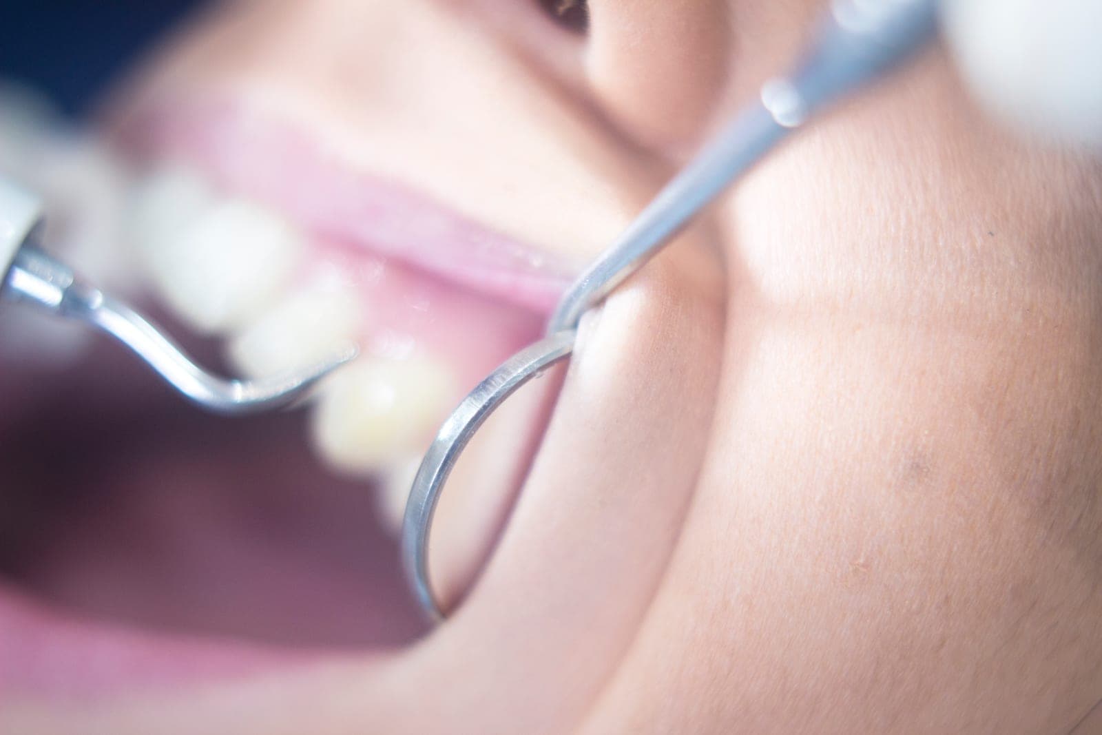 A dental hygienist carefully cleaning a patient's teeth at Brewery Yard Dental Surgery