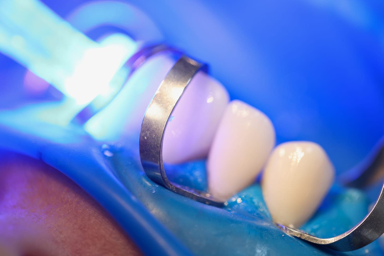 Close-up of careful restorative dental treatment at Brewery Yard Dental Surgery